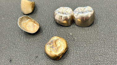 金歯・銀歯
